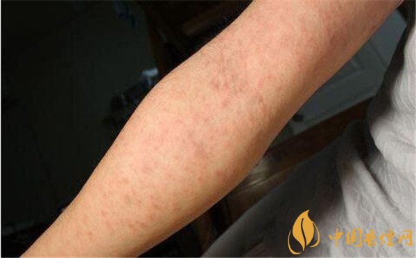 戒煙藥暢沛副作用有哪些 戒煙藥暢沛對人體的危害(有自殺風(fēng)險)